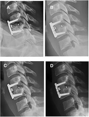 The safe and effective use of supercritical CO2-processed bone allografts for cervical and lumbar interbody fusion: A retrospective study